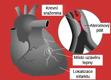 Ilustrace srdce s uzávěrem tepny, krevní sraženinou a lokalizací infarktu