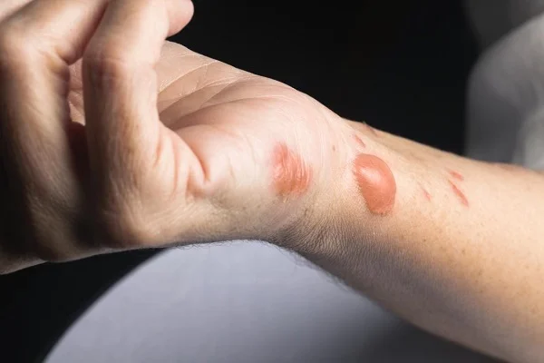 Popáleniny na ruce s puchýři a červenou kůží