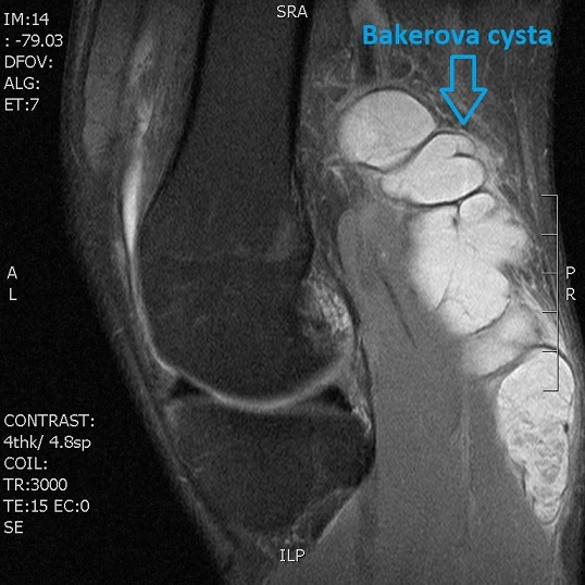 MRI kolene s označenou Bakerovou kystou